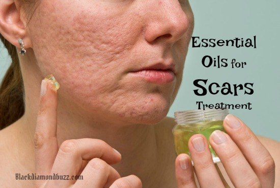 essential oils for scars treatment