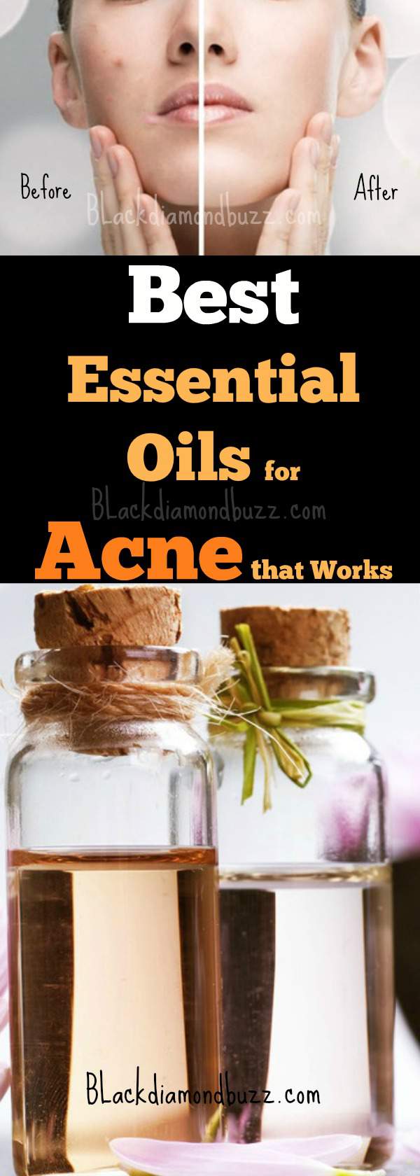 Essential oils for Acne and Pimples
