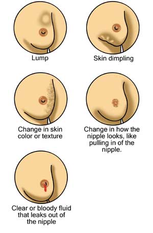 early symptoms of cancer 