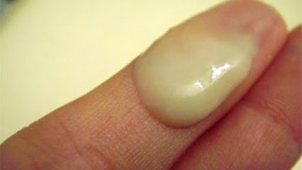 natural cures for bacterial vaginosis