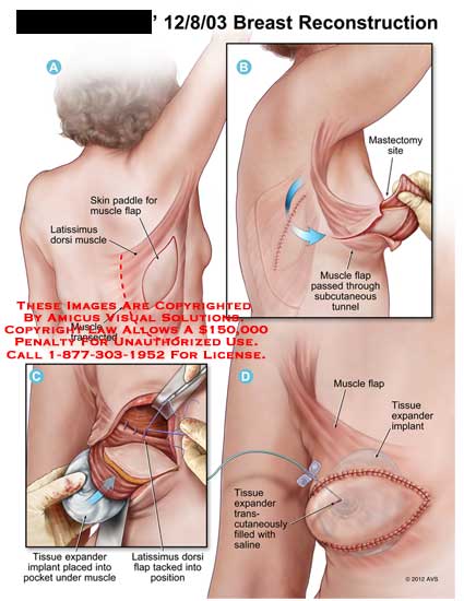 Mastectomy Breast Removal, is made for Life
