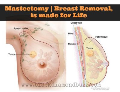 Mastectomy Breast Removal, is made for Life