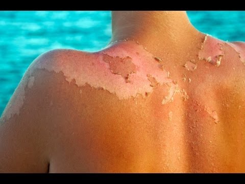 Best Home Remedies for Sunburn that work Fast