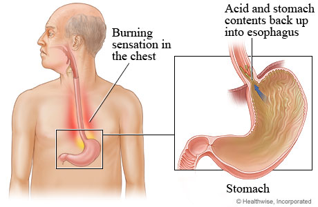 Here’s 8 Quick Heartburn Remedies That Work