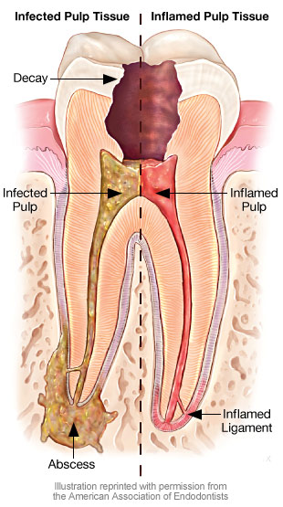 Home Remedies for Tooth Pain and Abscessed Tooth