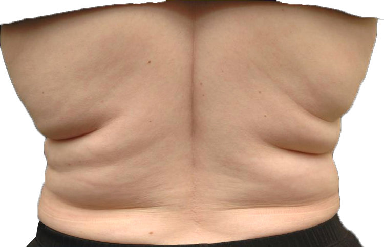 7 Best Exercises to Get Rid Of Back Fat At Home.