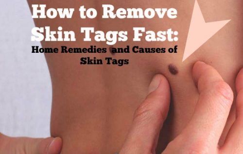 How to Remove Skin Tags Fast : Home Remedies  and Causes of Skin Tags