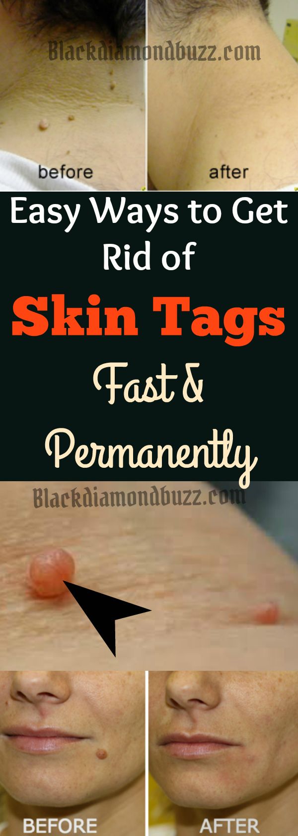 How to Remove Skin Tags Fast : Home Remedies  and Causes of Skin Tags