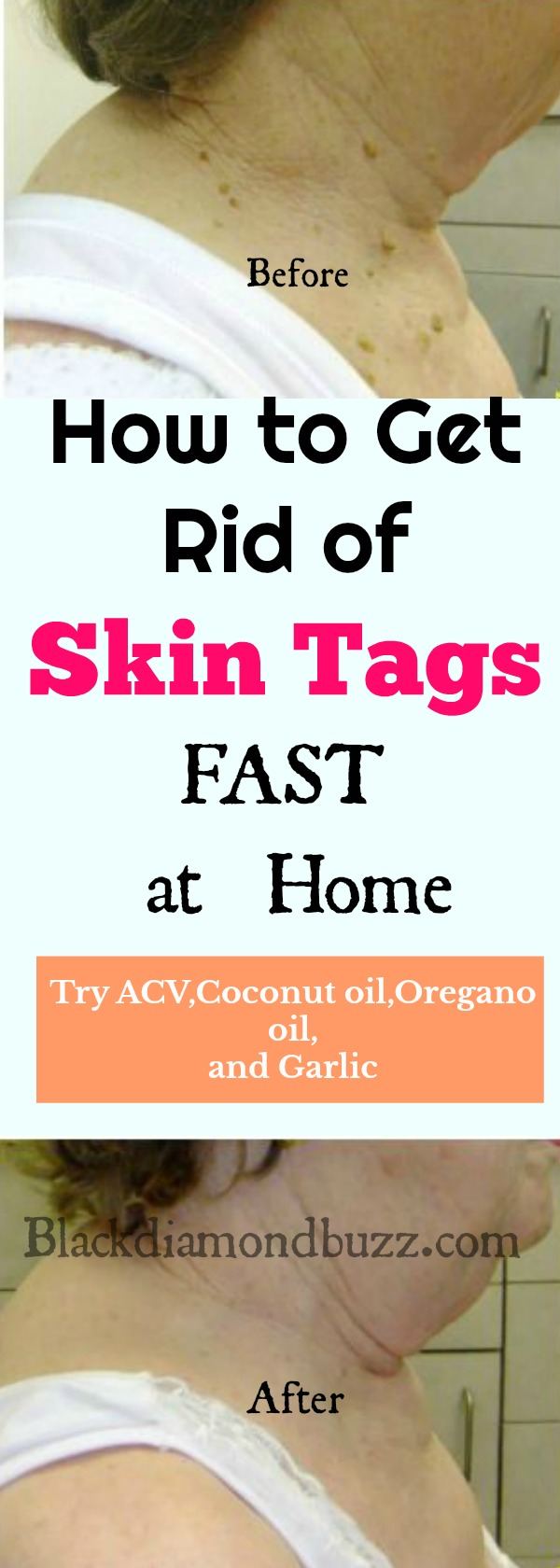 How to Remove Skin Tags Fast : Home Remedies  and Causes of Skin Tags