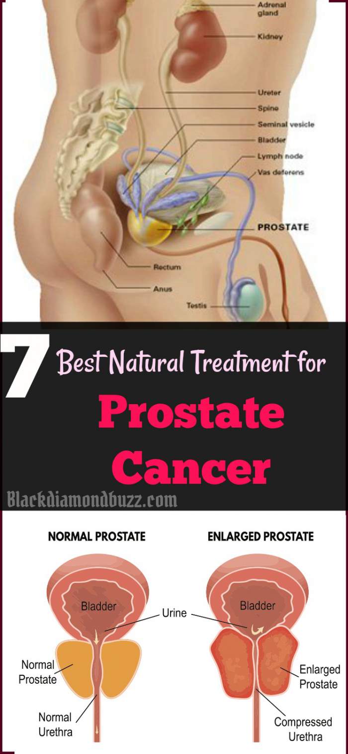 Prostate Cancer Treatment with Home Remedies that Work