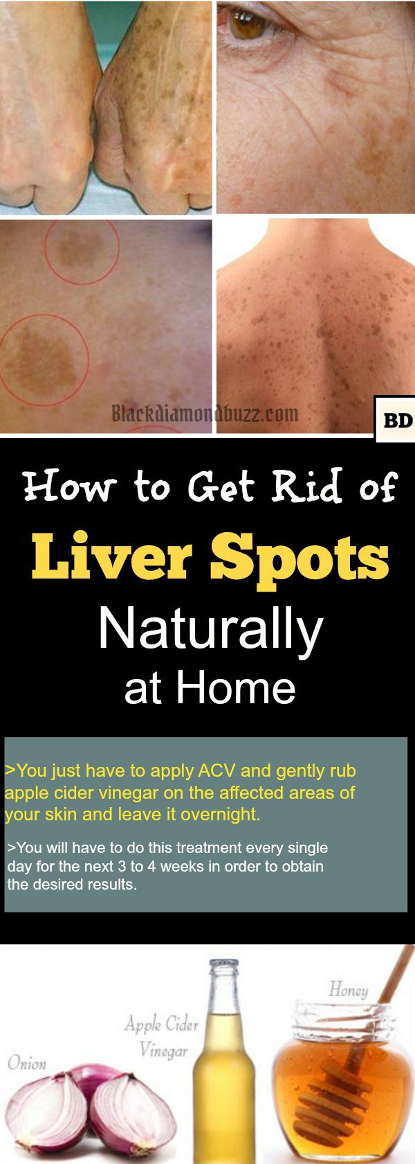 How to Get Rid of Liver Spots Naturally at Home