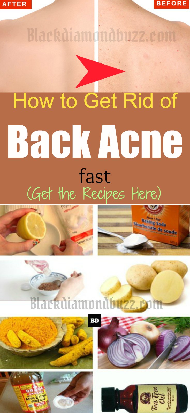 How to Get Rid of Back Acne Fast – 7 Best Home Remedies for Backne