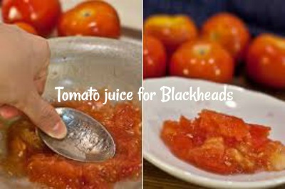 How to get rid of blackheads fast – 10 best home remedies