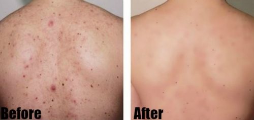 How to Get Rid of Back Acne Fast – 7 Best Home Remedies for Backne