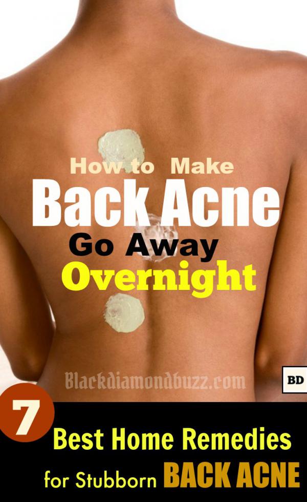 How to Get Rid of Back Acne Fast – 7 Best Home Remedies for Backne