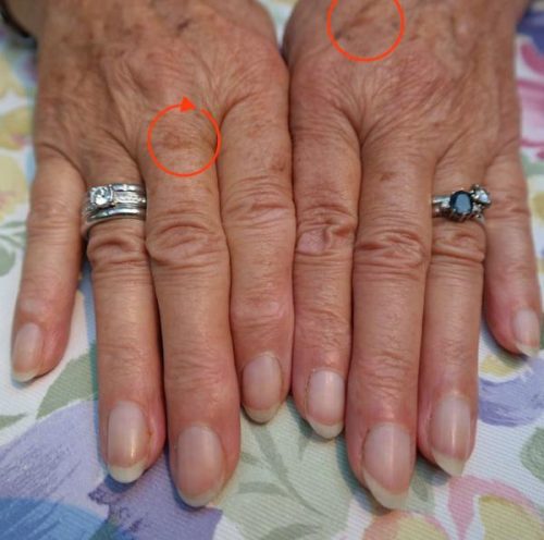 How to Get Rid of Liver Spots Naturally at Home