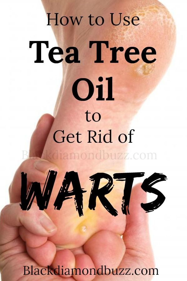 How to Use Tea Tree Oil to Get Rid of WARTS