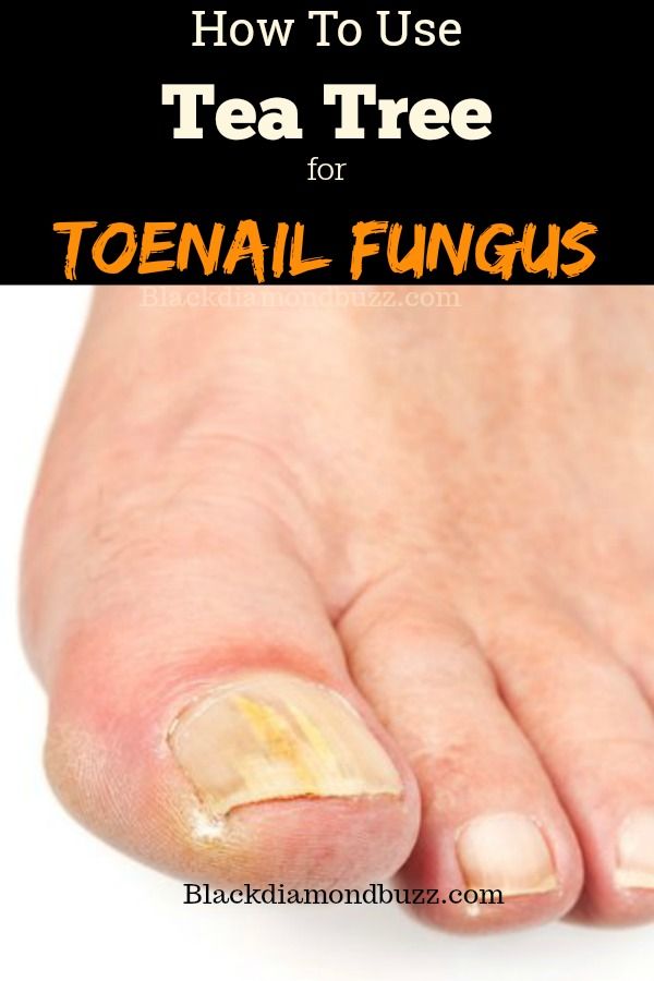 How to use tea tree for toenail fungus 