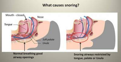 How to Stop Snoring Naturally and Permanently- 12 Solutions that Work