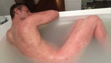 How to Cure Eczema Permanently - 10 Home Remedies for Eczema