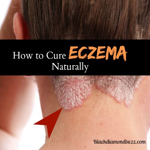 How to Cure Eczema Permanently 10 Home Remedies for Eczema