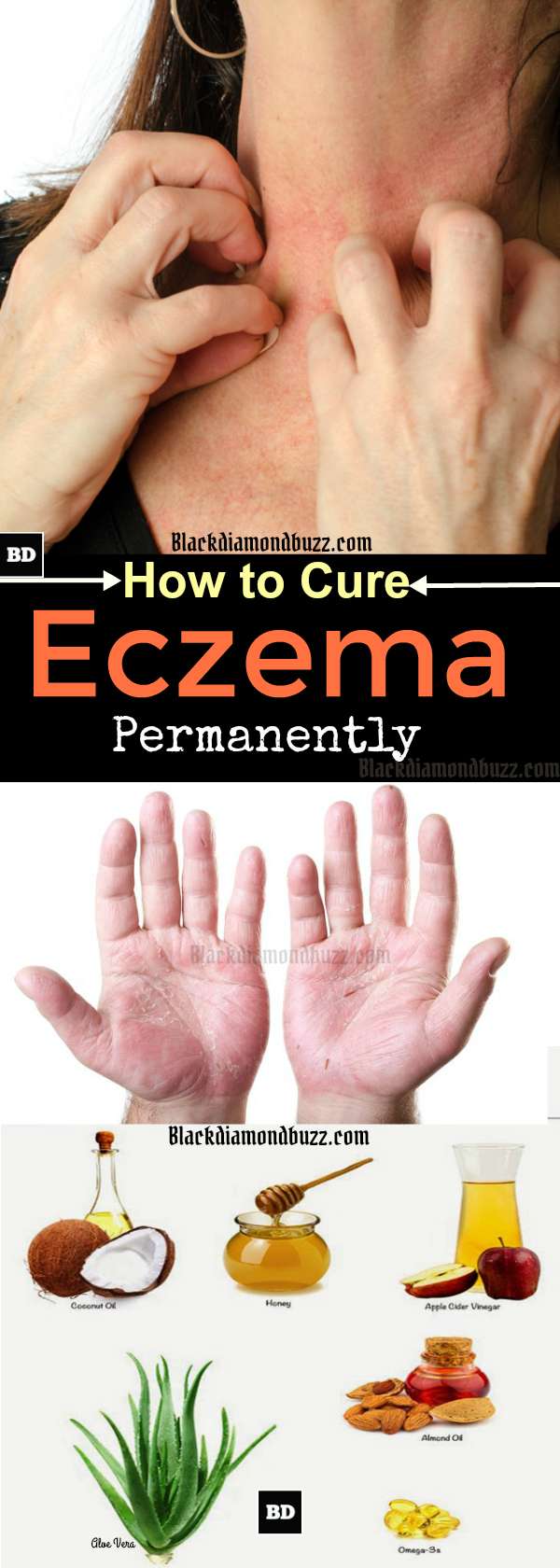How to Cure Eczema Permanently - 10 Home Remedies for Eczema