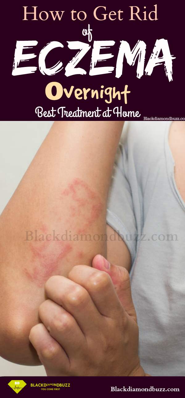 How to Cure Eczema Permanently - 10 Home Remedies for Eczema