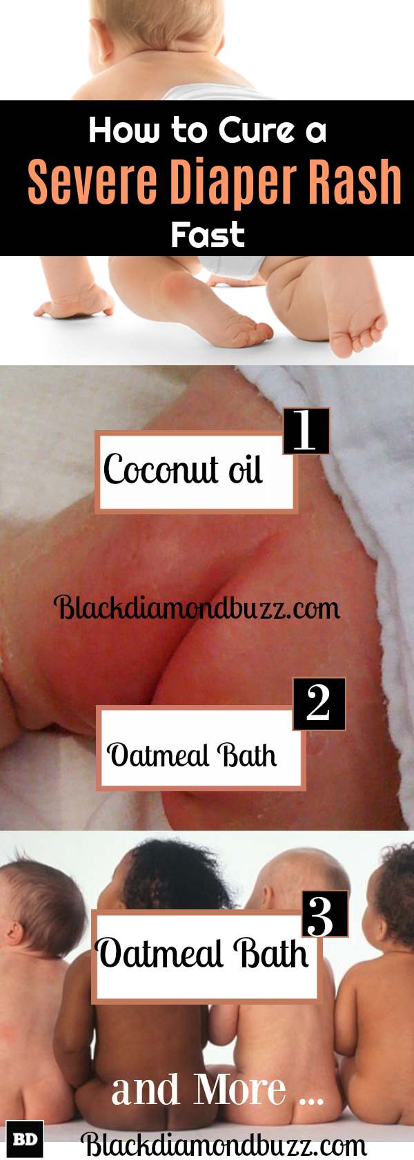 Best Home Remedies for Diaper Rash: Treatments to Get Rid of Diaper Rash In 24 Hours