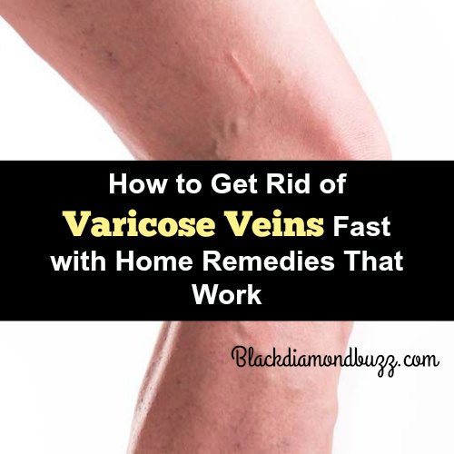 How to Get Rid of Varicose Veins Fast with Home Remedies That Work