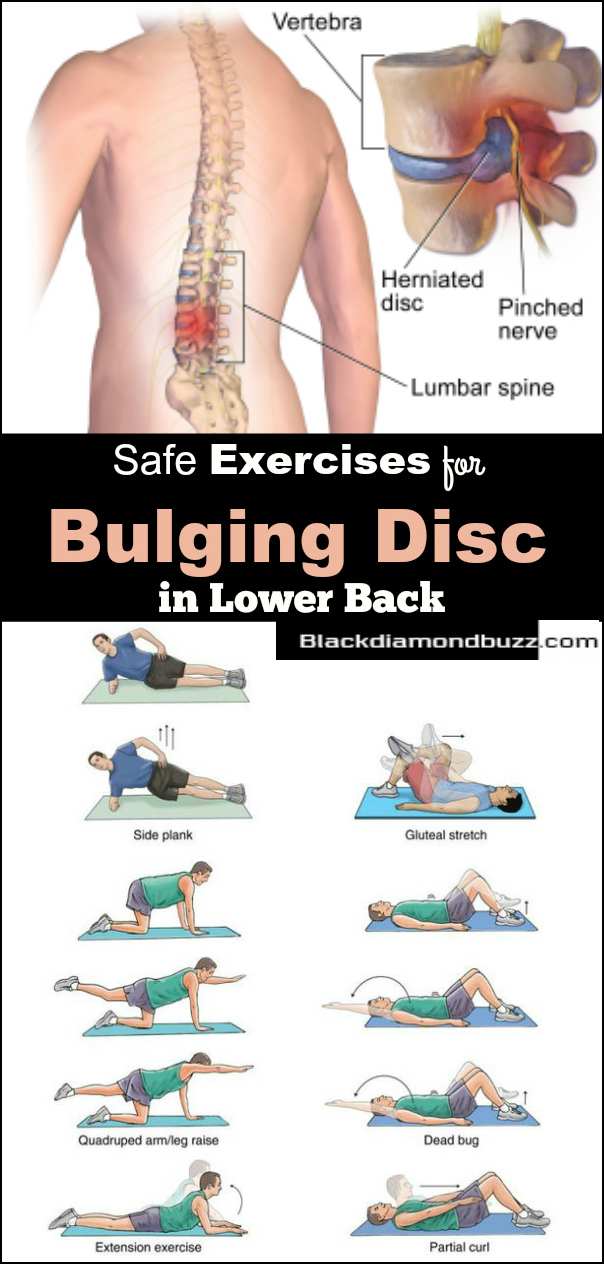Exercises for bulging disc in lower back