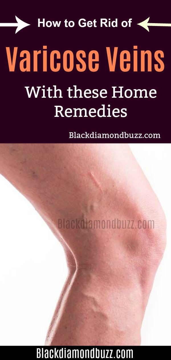 How to Get Rid of Varicose Veins Fast with Home Remedies That Work