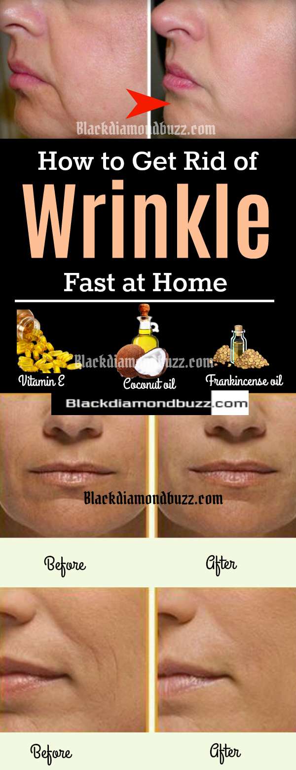 how to get rid of wrinkle permanently